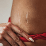 Stretch Marks Don't Have to Be a Lifetime Companion